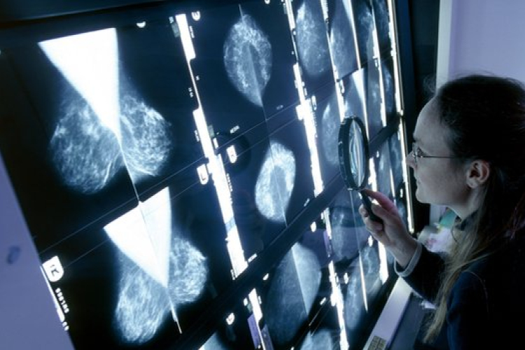 Mellrákot okozhat a koleszterin?