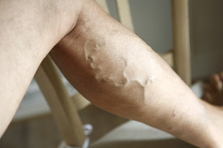 Visszeresek figyelem: jön a melegedés, és vele a lábfájdalom