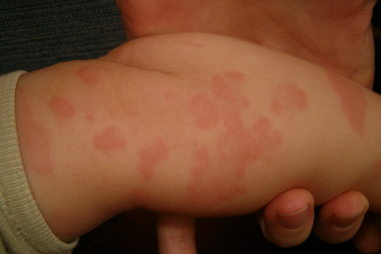 Egy életen át tartó betegség lehet az ekcéma